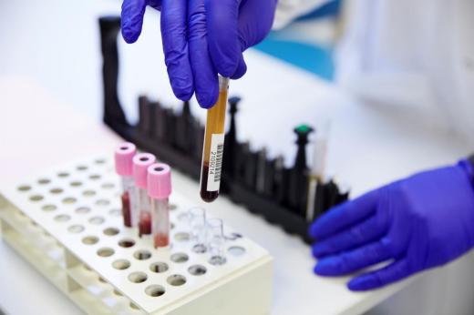 Using blood tests (liquid biopsy) to prevent relapse in breast cancer patients