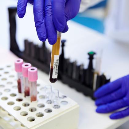  Using blood tests (liquid biopsy) to prevent relapse in breast cancer patients