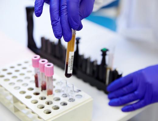  Using blood tests (liquid biopsy) to prevent relapse in breast cancer patients
